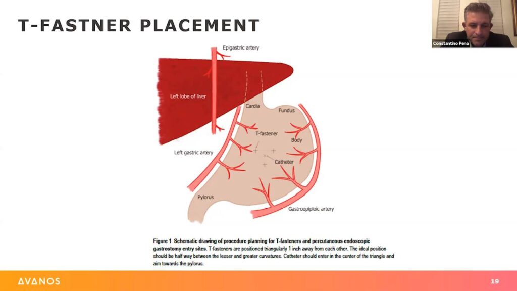 Dr. Pena - Percutaneous Gastropexy and its role in Feeding Tube Placement