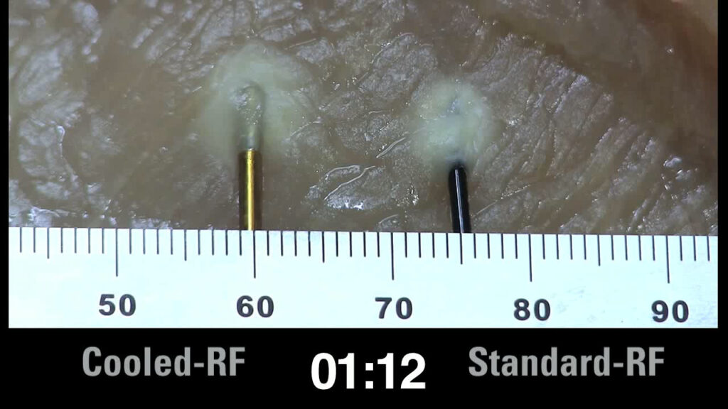 Cooled RF vs. Standard RF - Side by Side Comparison